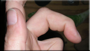 Ringfinger bänderriss Geschwollene Finger